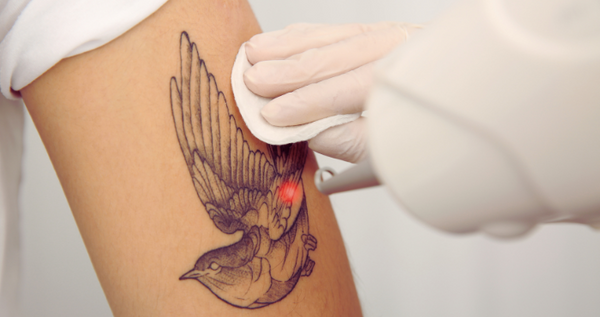 Effektiv tatoveringsfjerning med Picosure laser hos AQP