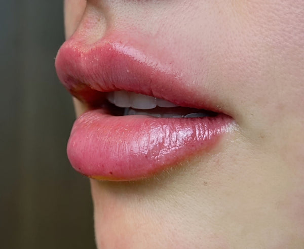 Fillers - Leppefyll