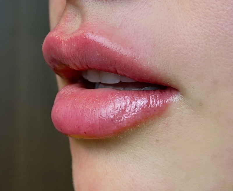 Fillers - Leppefyll