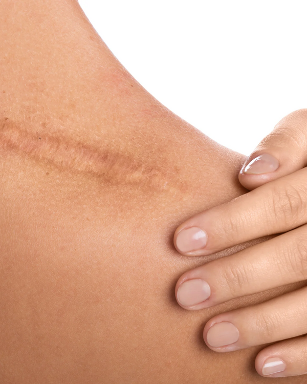 Scar & Striae Remodel Therapy