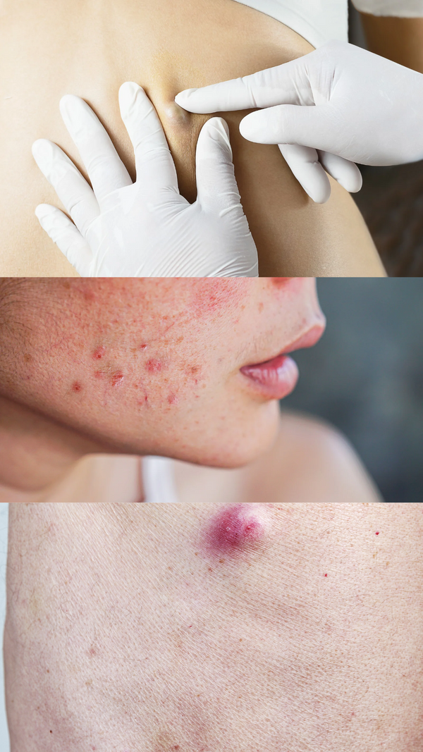 Spots & Bumps Therapy