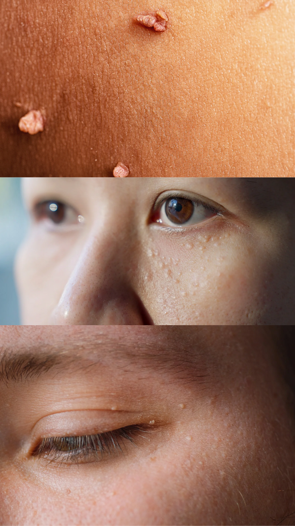 Skintags & Milia Therapy