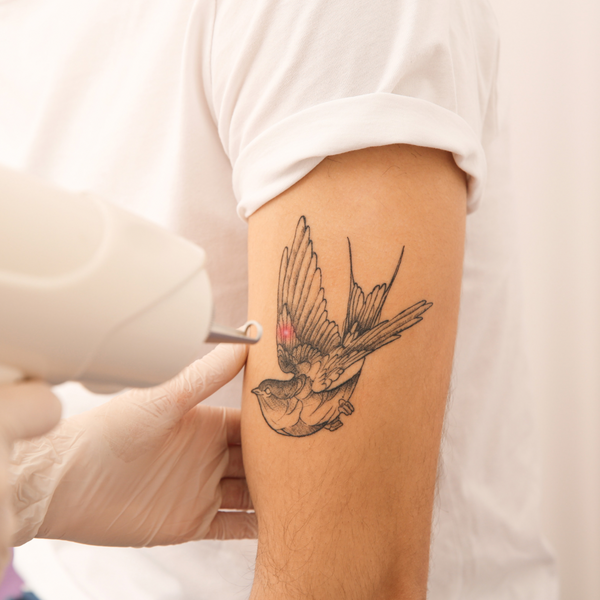 Tatoveringsfjerning